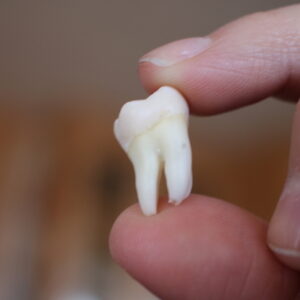 Wisdom tooth Removal