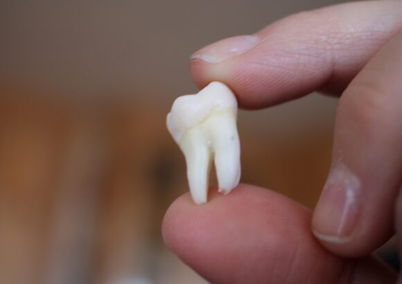 Wisdom tooth Removal